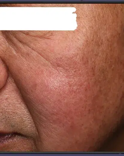 Age Spots / Sun Spots — After Treatment · Case 56 · Luowei Medical Aesthetics Clinic
