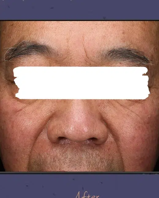 Age Spots / Sun Spots After Treatment · Case 57 · Luowei Medical Aesthetics Clinic