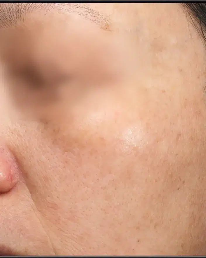 Melasma After Treatment · Case 45 · Luowei Medical Aesthetics Clinic