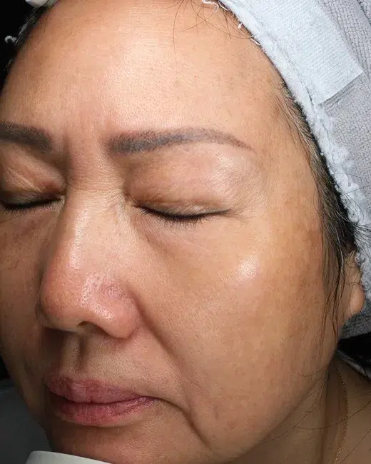 Melasma After Treatment · Case 46 · Luowei Medical Aesthetics Clinic