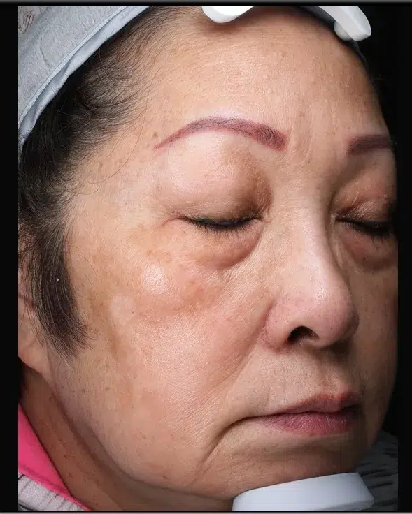 Age Spots / Sun Spots — After Treatment · Case 60 · Luowei Medical Aesthetics Clinic