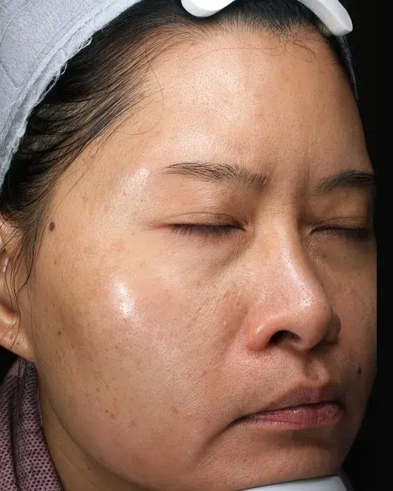 Melasma After Treatment · Case 49 · Luowei Medical Aesthetics Clinic