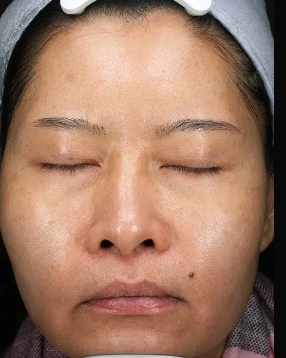Melasma After Treatment · Case 52 · Luowei