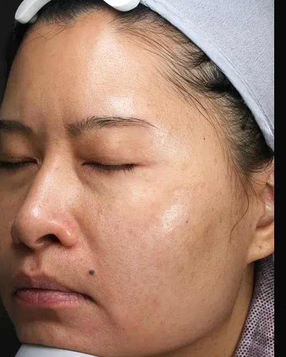 Melasma After Treatment · Case 53 · Luowei Medical Aesthetics Clinic
