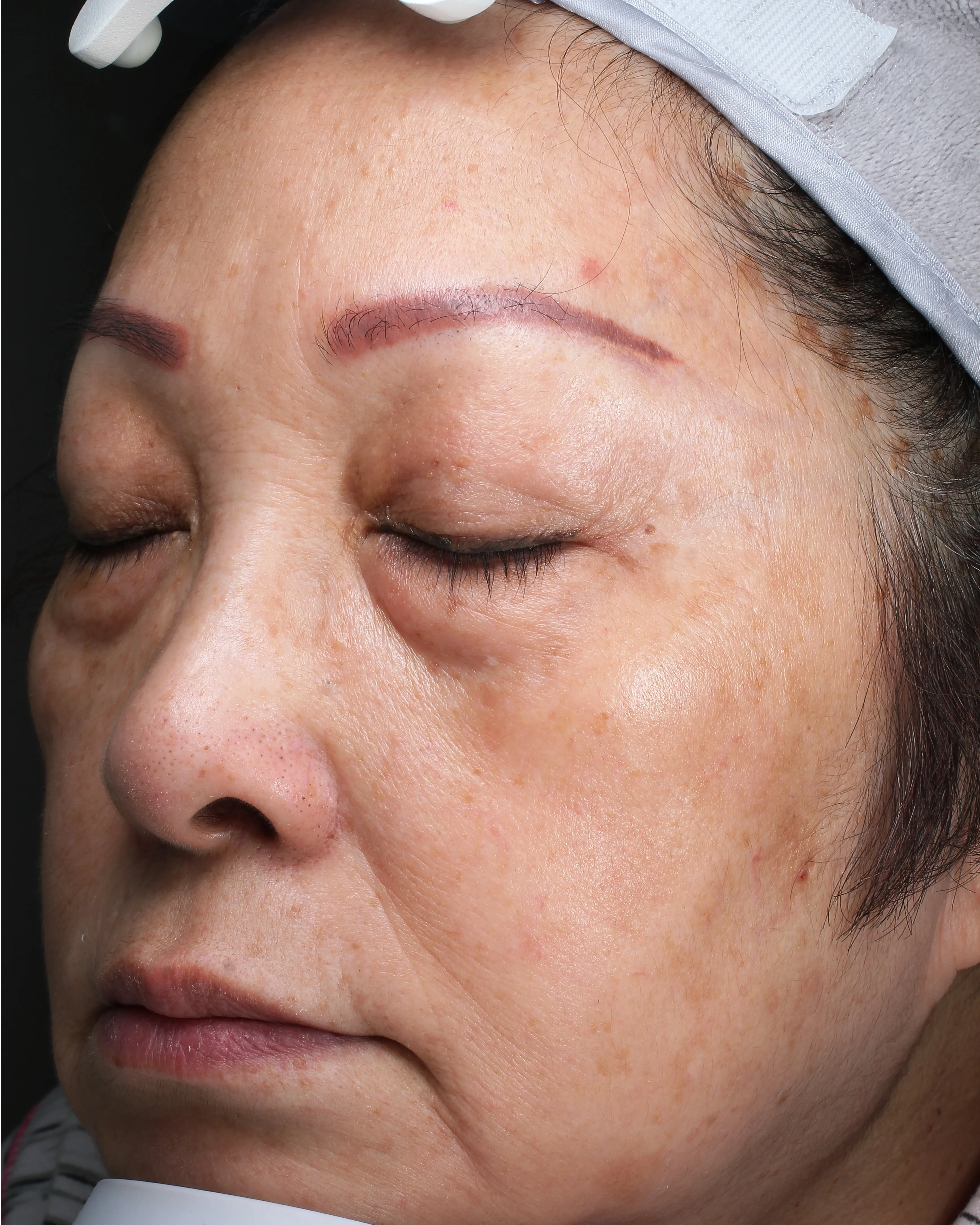Age Spots / Sun Spots — After · Case 64 · Luowei Medical Aesthetics Clinic
