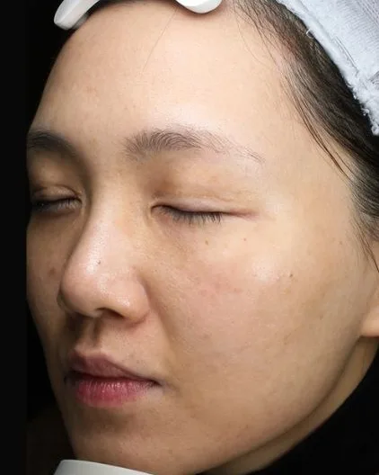 Melasma After Treatment · Case 71 · Luowei Medical Aesthetics Clinic