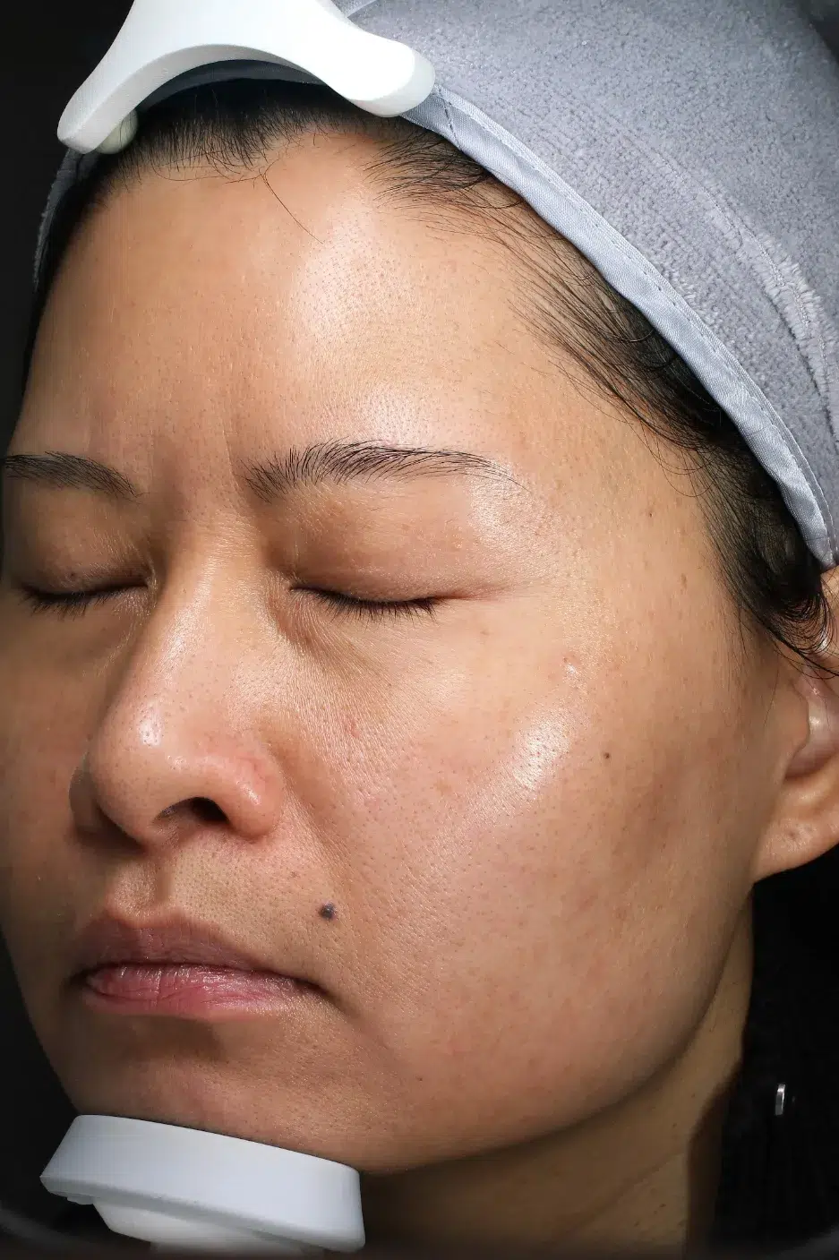 Age Spots / Sun Spots — After Treatment · Case 66 · Luowei Medical Aesthetics Clinic