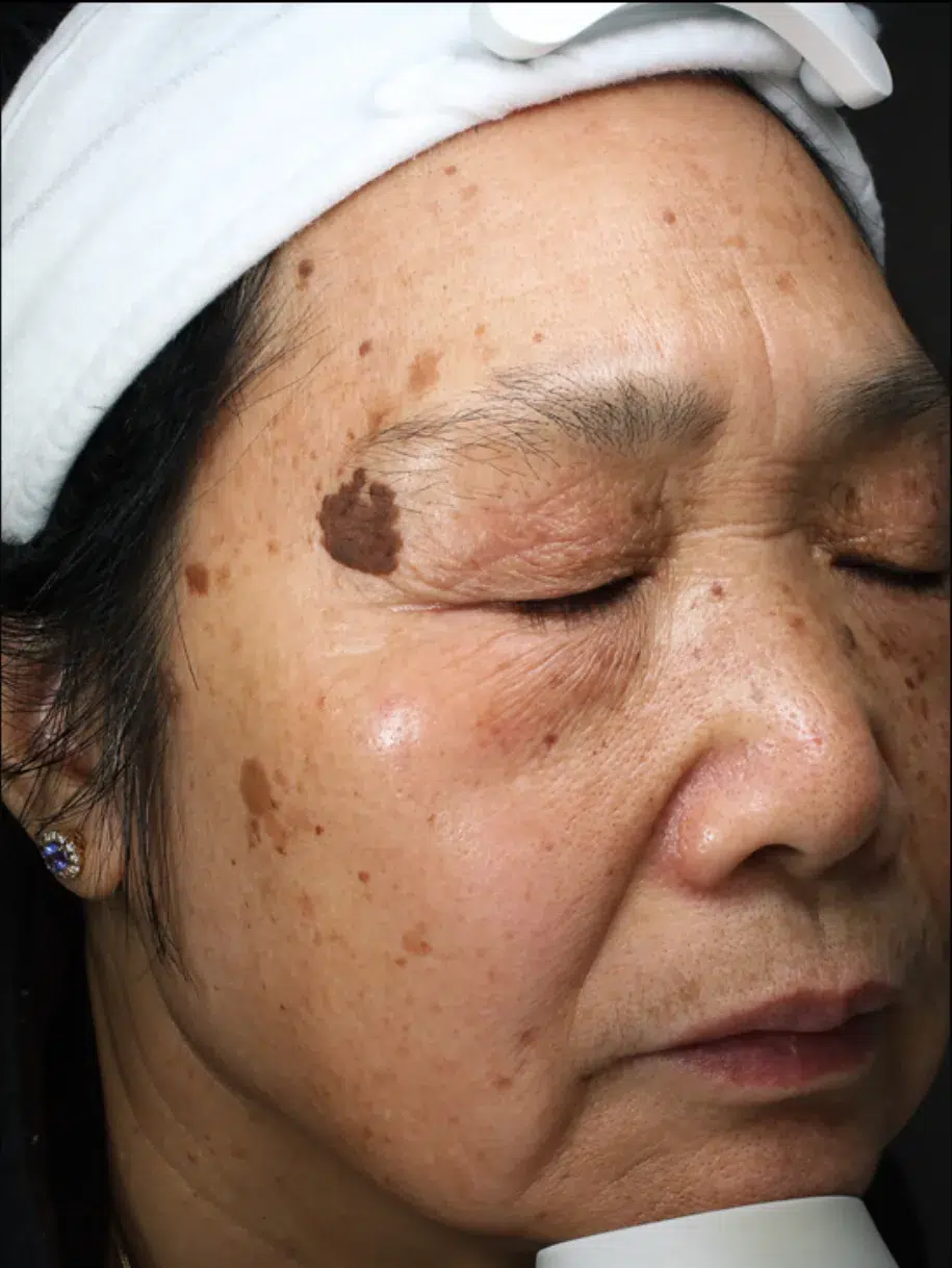 Age Spots / Sun Spots — Before · Case 3 · Luowei Medical Aesthetics Clinic