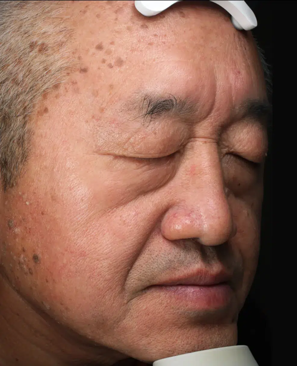 Age Spots / Sun Spots — Before Treatment · Case 5 · Luowei Medical Aesthetics Clinic