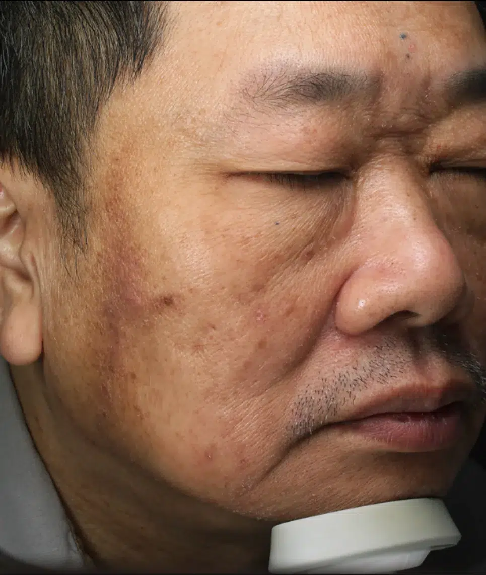 Age Spots / Sun Spots — Before Treatment · Case 7 · Luowei Medical Aesthetics Clinic
