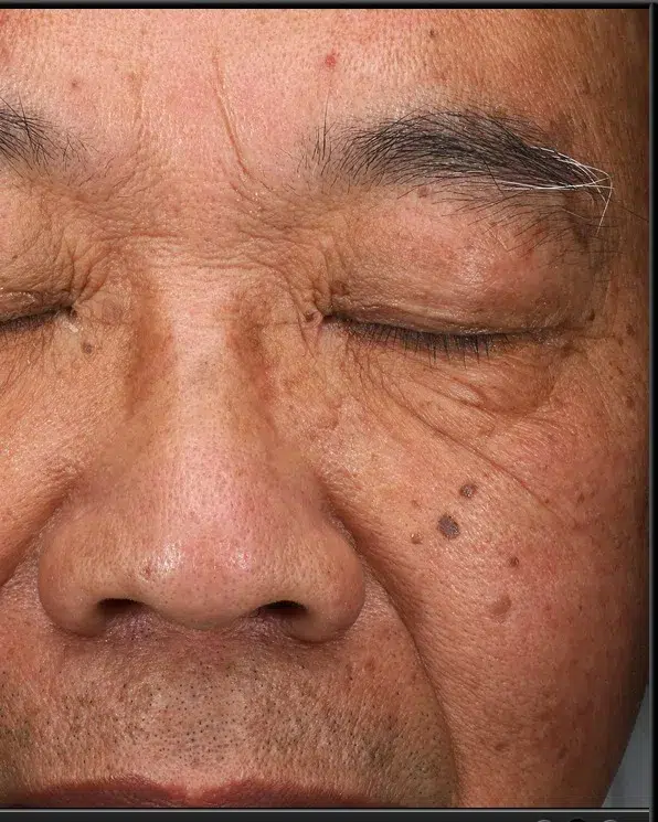 Freckles Before Treatment · Case 38 · Luowei Medical Aesthetics Clinic