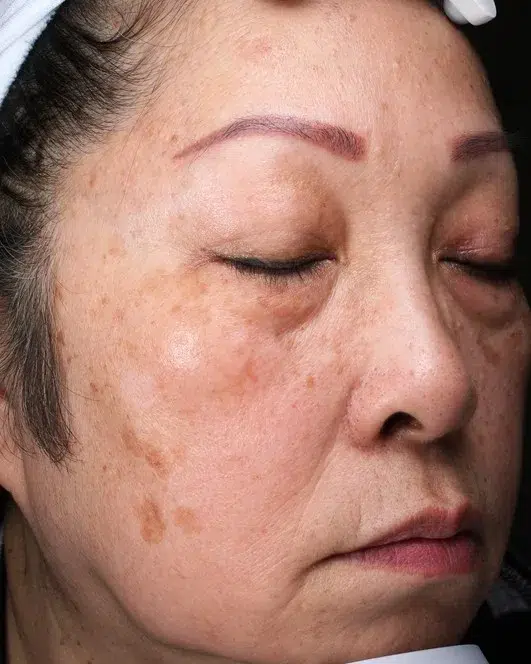 Freckles Before Treatment · Case 39 · Luowei Medical Aesthetics Clinic