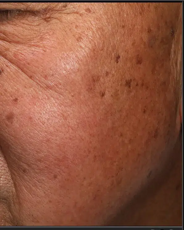 Freckles Before Treatment · Case 40 · Luowei Medical Aesthetics Clinic