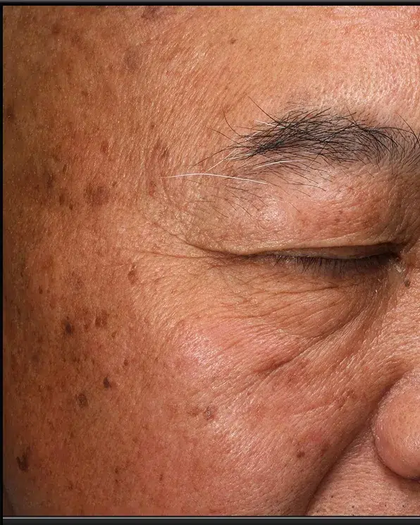 Freckles Before Treatment · Case 41 · Luowei Medical Aesthetics Clinic