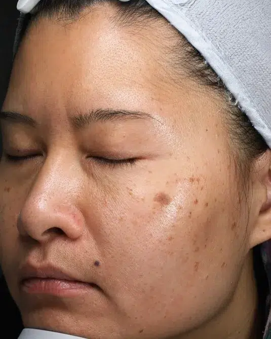 Freckles Before Treatment · Case 42 · Luowei Medical Aesthetics Clinic