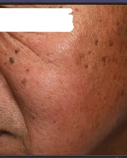 Age Spots / Sun Spots Before Treatment · Case 56 · Luowei Medical Aesthetics Clinic