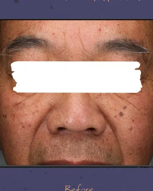 Age Spots / Sun Spots — Before Treatment · Case 57 · Luowei Medical Aesthetics Clinic