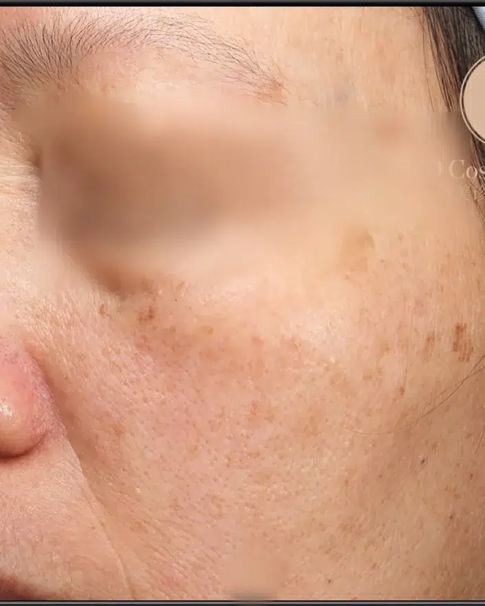 Melasma Before Treatment · Case 45 · Luowei