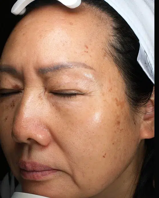Melasma Before Treatment · Case 46 · Luowei Medical Aesthetics Clinic