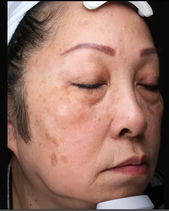Age Spots / Sun Spots — Before Treatment · Case 60 · Luowei Medical Aesthetics Clinic