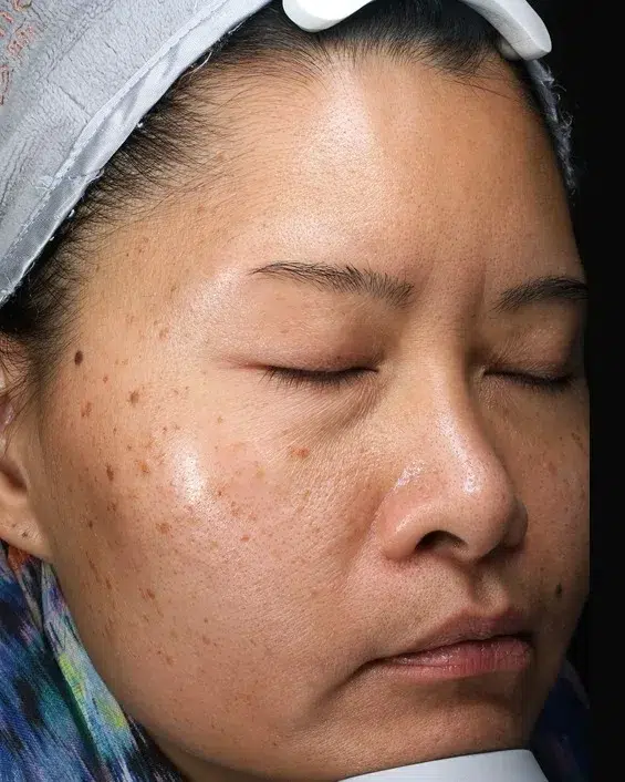 Melasma Before Treatment · Case 49 · Luowei Medical Aesthetics Clinic