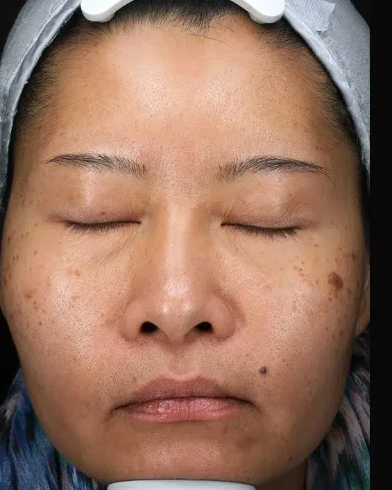Melasma Before Treatment · Case 52 · Luowei Medical Aesthetics Clinic