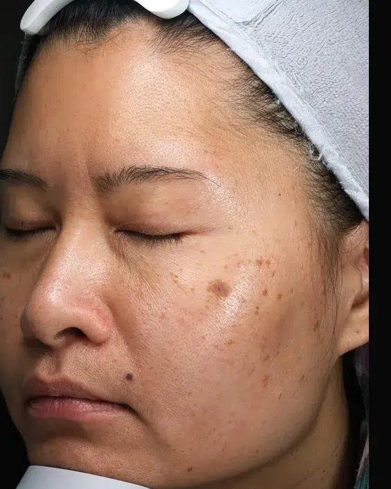 Melasma Before Treatment · Case 53 · Luowei