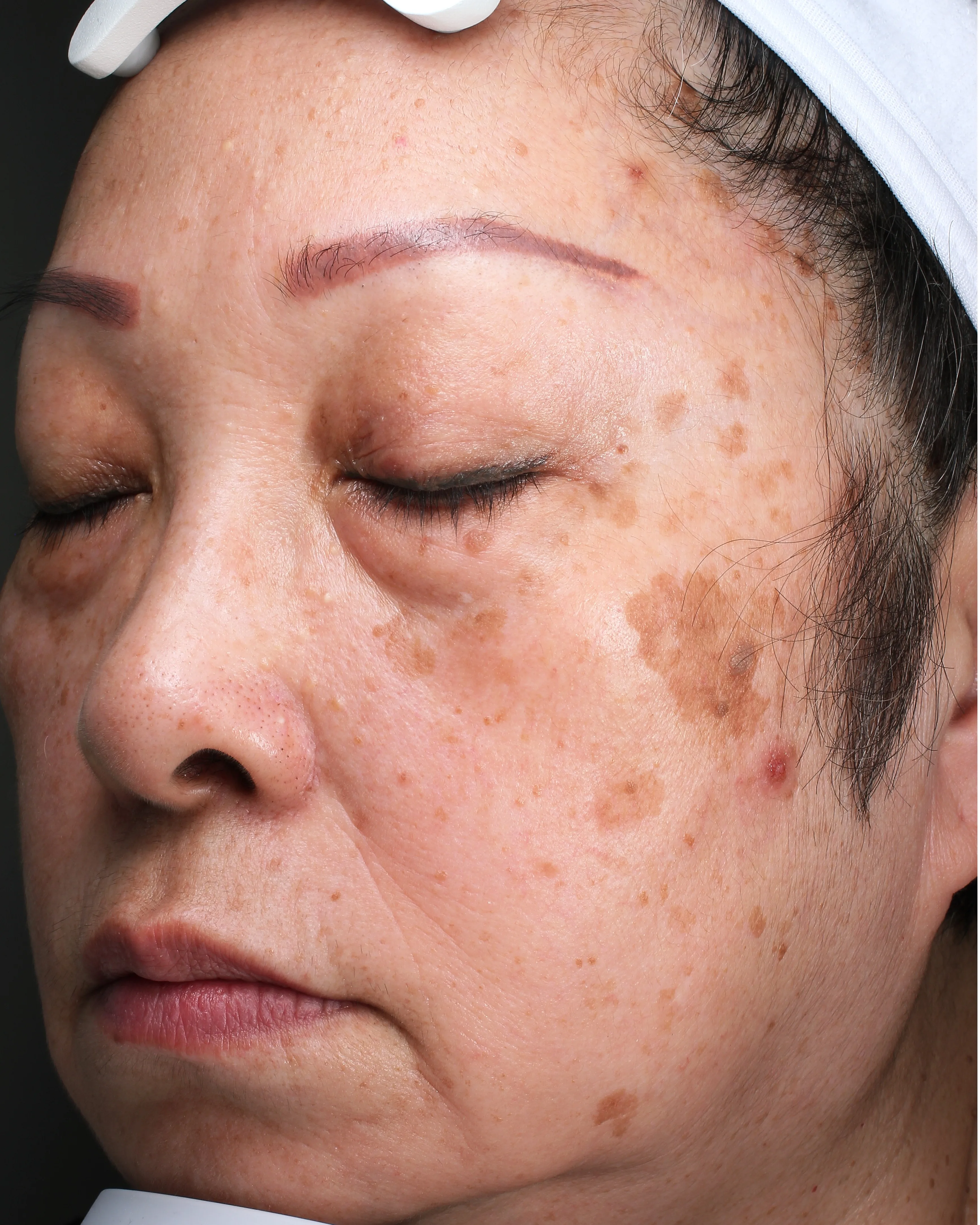 Age Spots / Sun Spots — Before Treatment · Case 64 · Luowei Medical Aesthetics Clinic