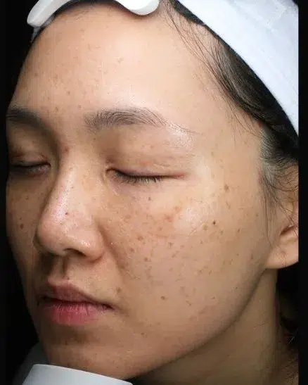 Melasma Before Treatment · Case 71 · Luowei Medical Aesthetics Clinic