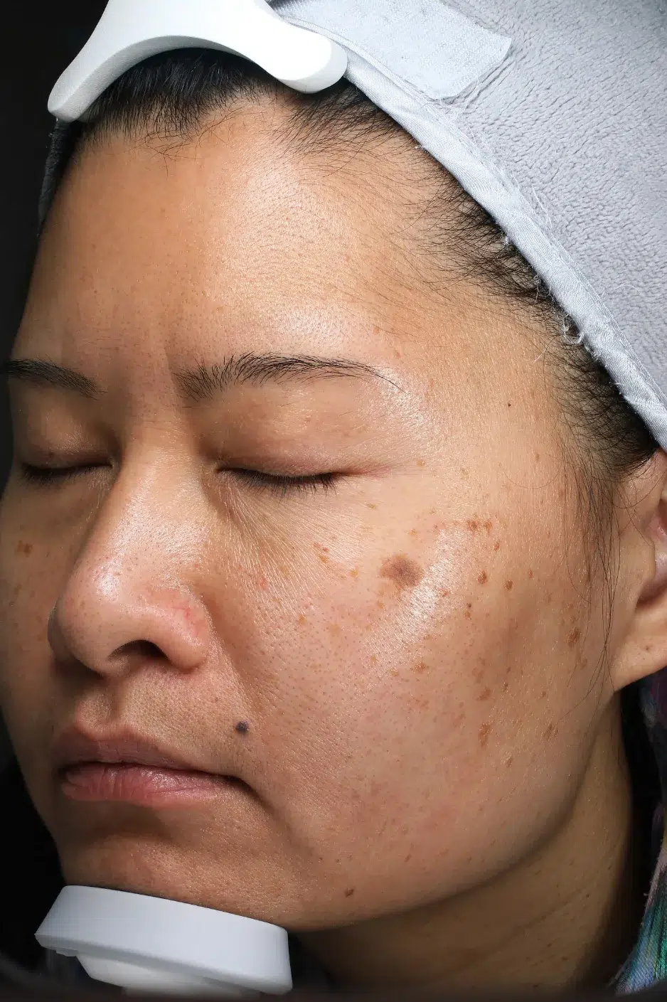 Age Spots / Sun Spots Before Treatment · Case 66 · Luowei Medical Aesthetics Clinic