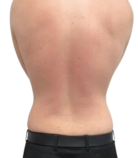 Weight Gain & Body Fat Increase After · Case 4 · Luowei Medical Aesthetics Clinic