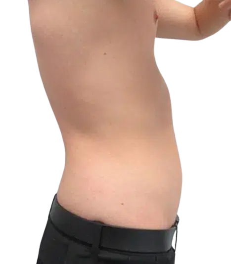 Weight Gain & Body Fat Increase After Treatment · Case 5 · Luowei Medical Aesthetics Clinic
