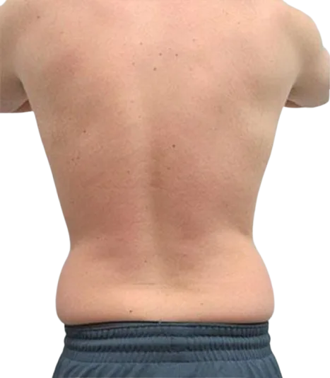 Weight Gain & Body Fat Increase Before · Case 4 · Luowei Medical Aesthetics Clinic