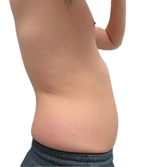 Weight Gain & Body Fat Increase Before Treatment · Case 5 · Luowei Medical Aesthetics Clinic