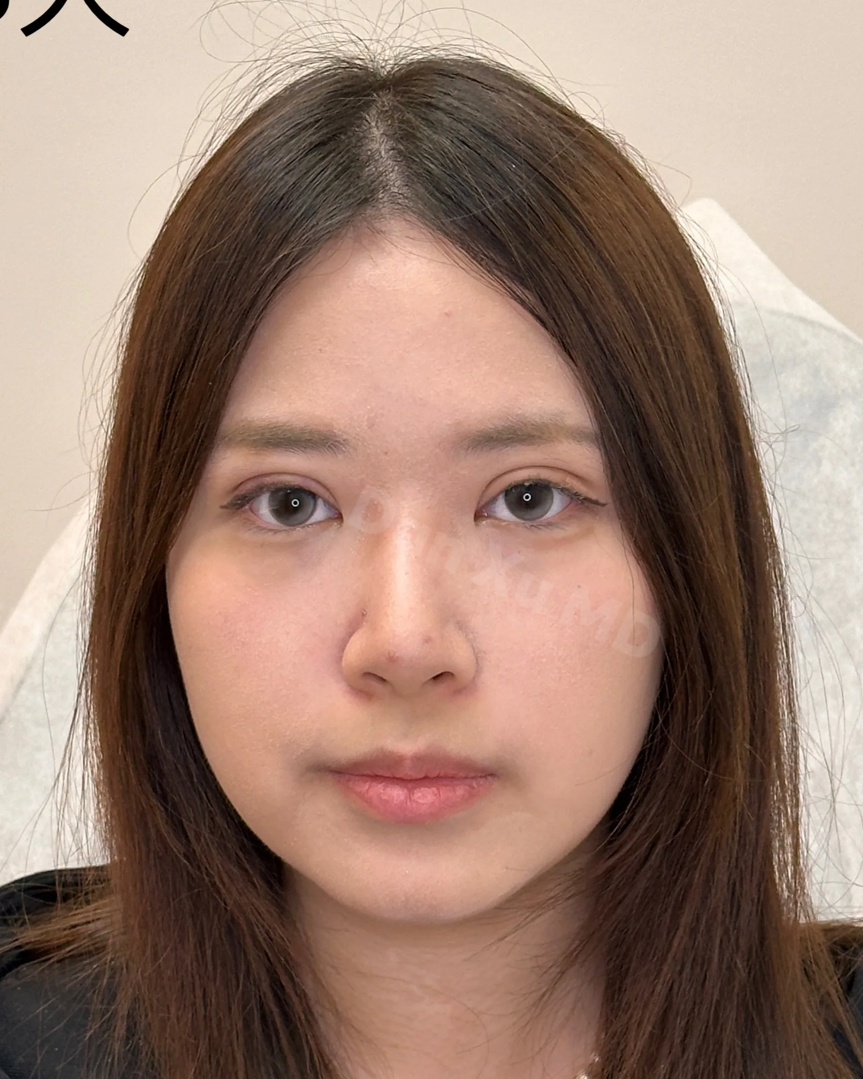 Upper Eyelid Ptosis After Treatment · Case 06 · Luowei Medical Aesthetics Clinic