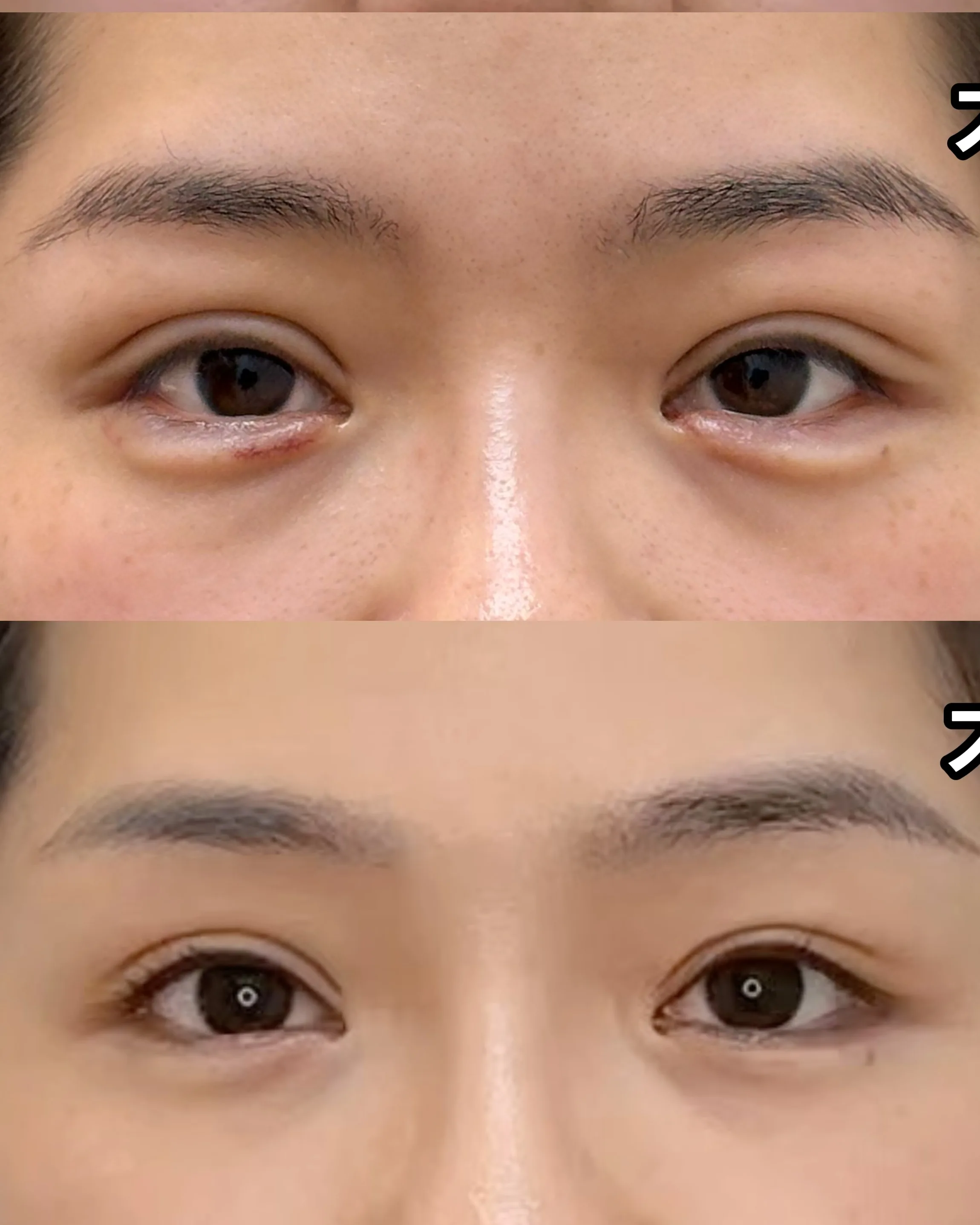 Upper Eyelid Ptosis — After Treatment · Case 14 · Luowei Medical Aesthetics Clinic