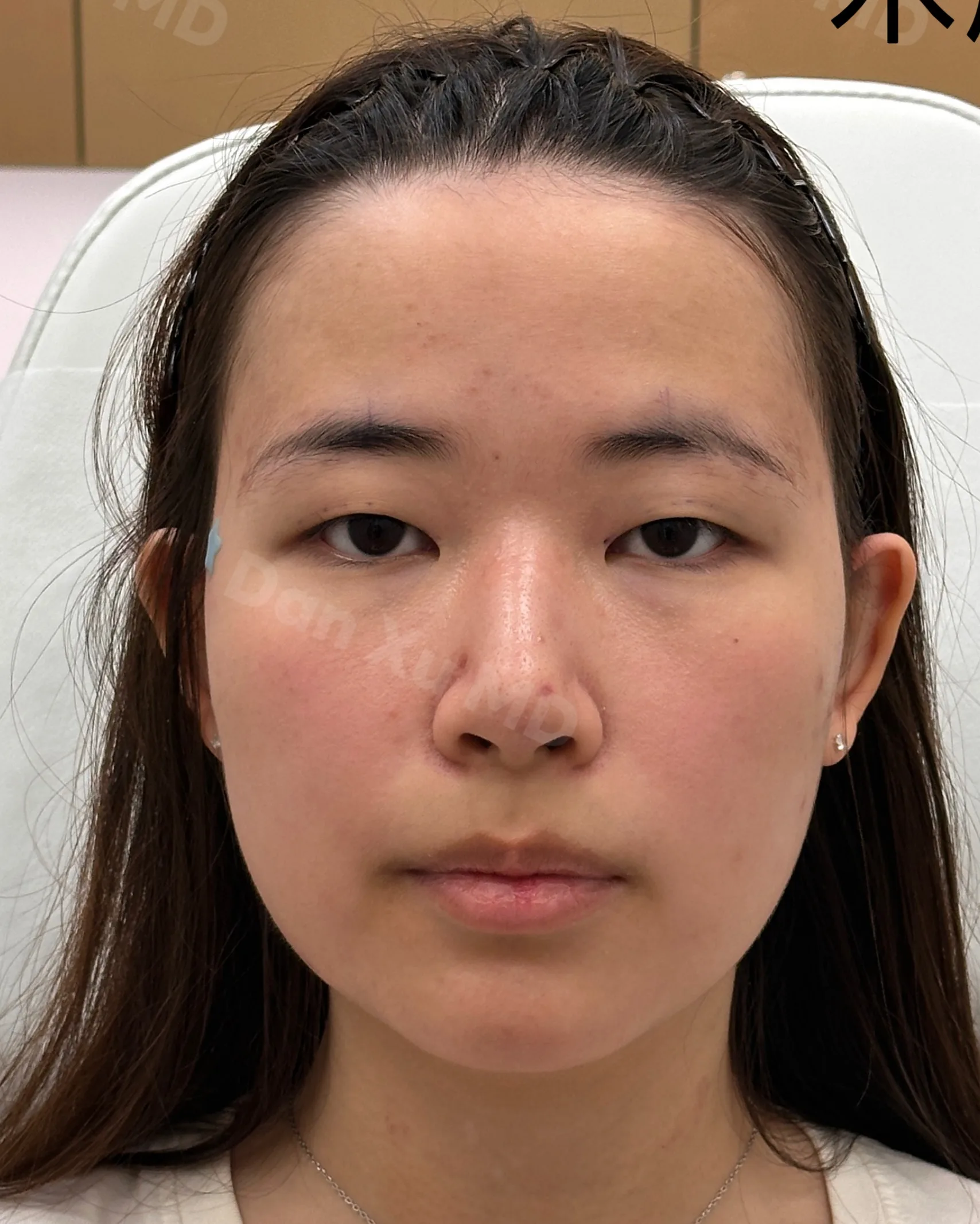Upper Eyelid Ptosis Before Treatment · Case 06 · Luowei Medical Aesthetics Clinic
