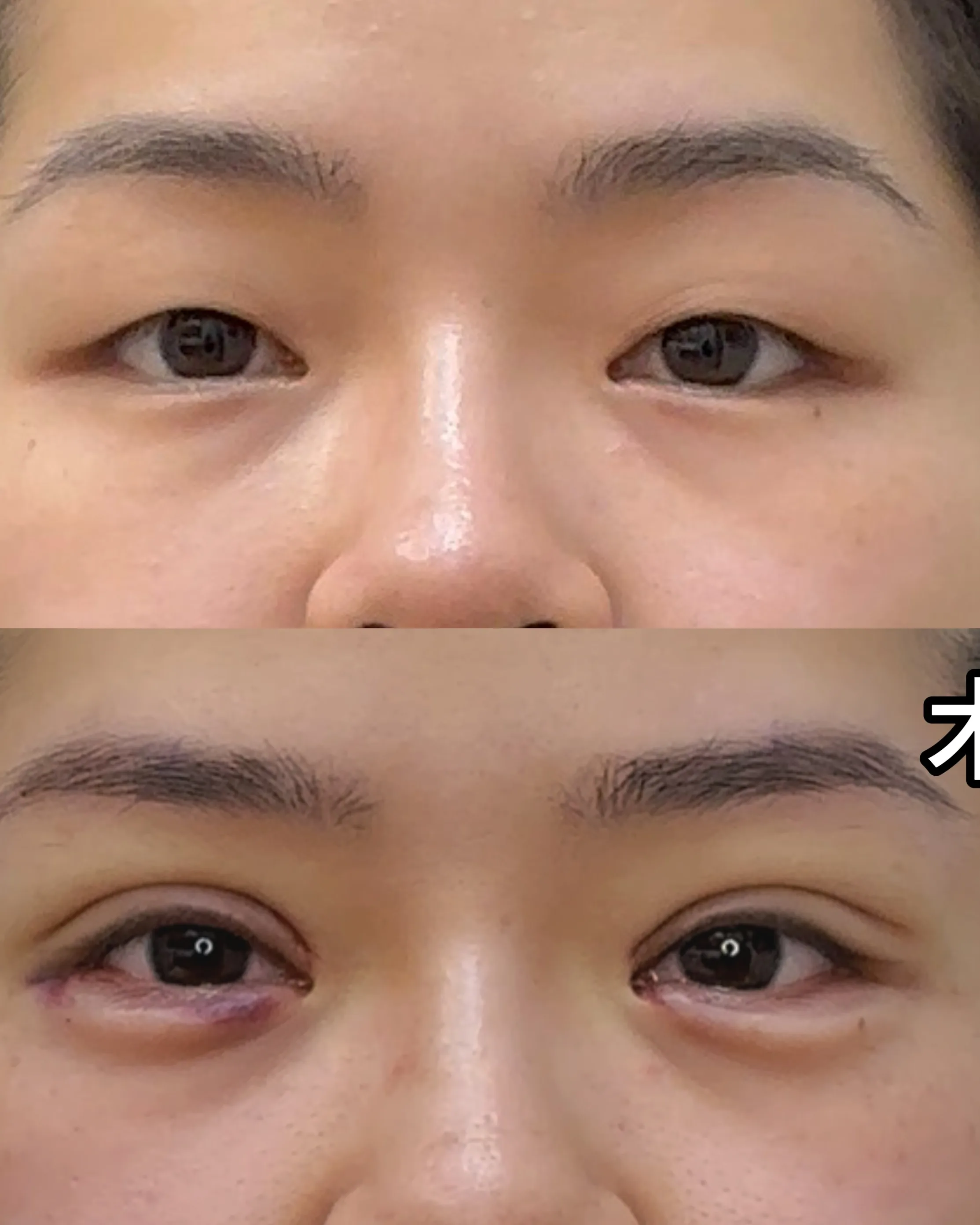 Upper Eyelid Ptosis Before Treatment · Case 14 · Luowei Medical Aesthetics Clinic
