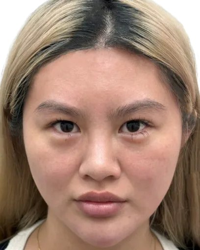 Telangiectasia — After Treatment · Case 02 · Luowei Medical Aesthetics Clinic