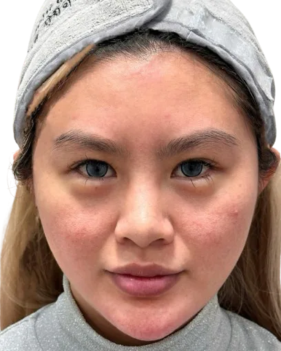 Telangiectasia Before Treatment · Case 02 · Luowei Medical Aesthetics Clinic