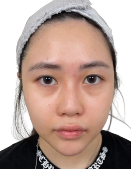 Baby fat / chubby cheeks After · Case 2 · Luowei Medical Aesthetics Clinic