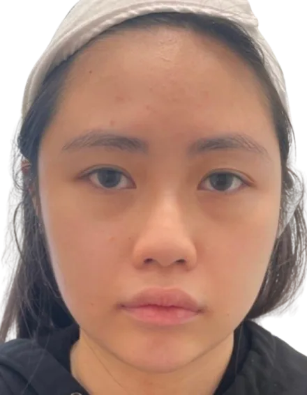 Baby fat / chubby cheeks · before · Case 2 · Luowei Medical Aesthetics Clinic
