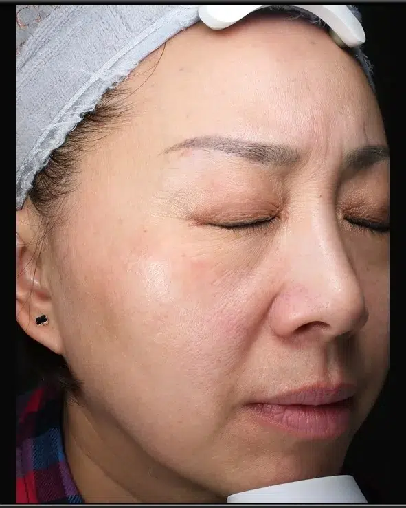 Pigmented Lesions — After Treatment · Case 9 · Luowei Medical Aesthetics Clinic