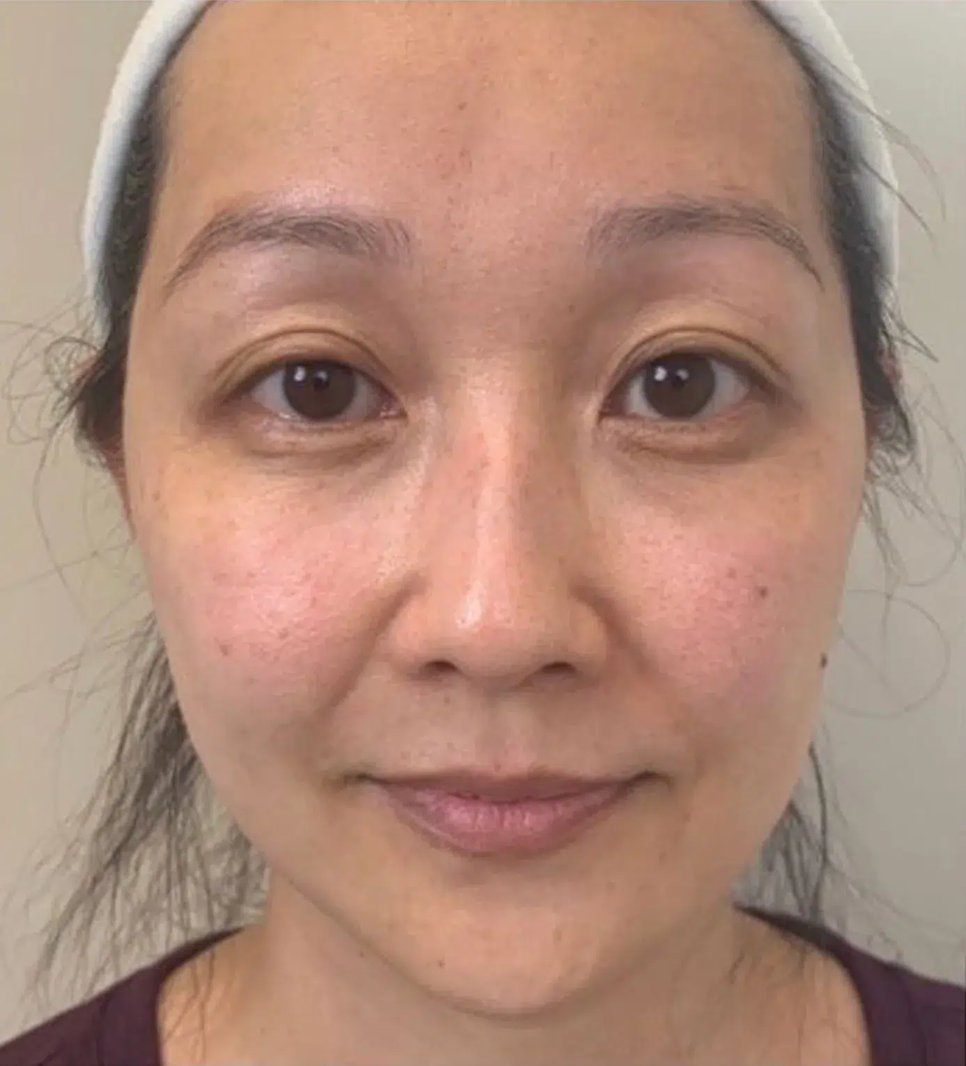 Freckles After Treatment · Case 07 · Luowei Medical Aesthetics Clinic