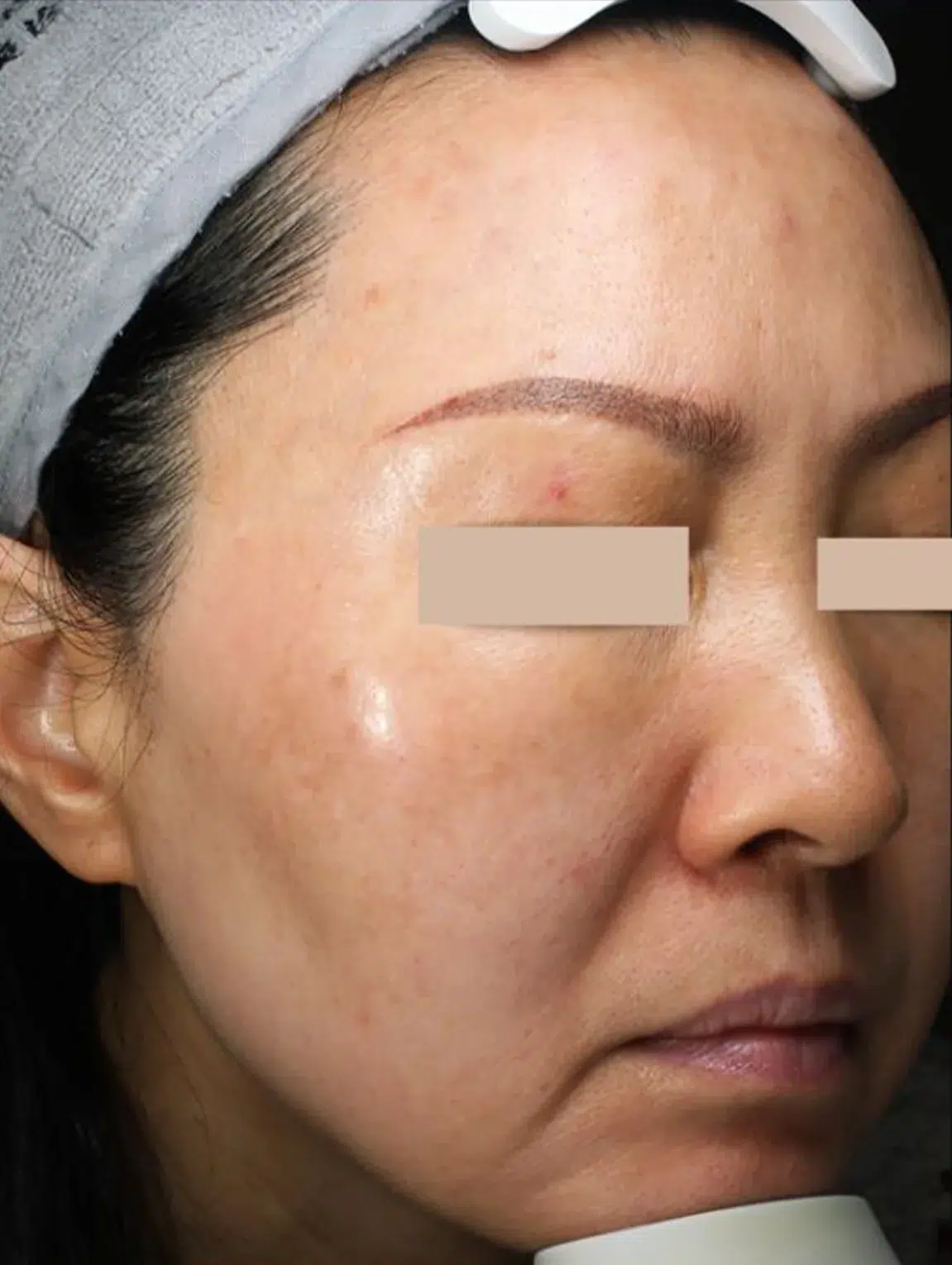 Freckles After Treatment · Case 08 · Luowei Medical Aesthetics Clinic