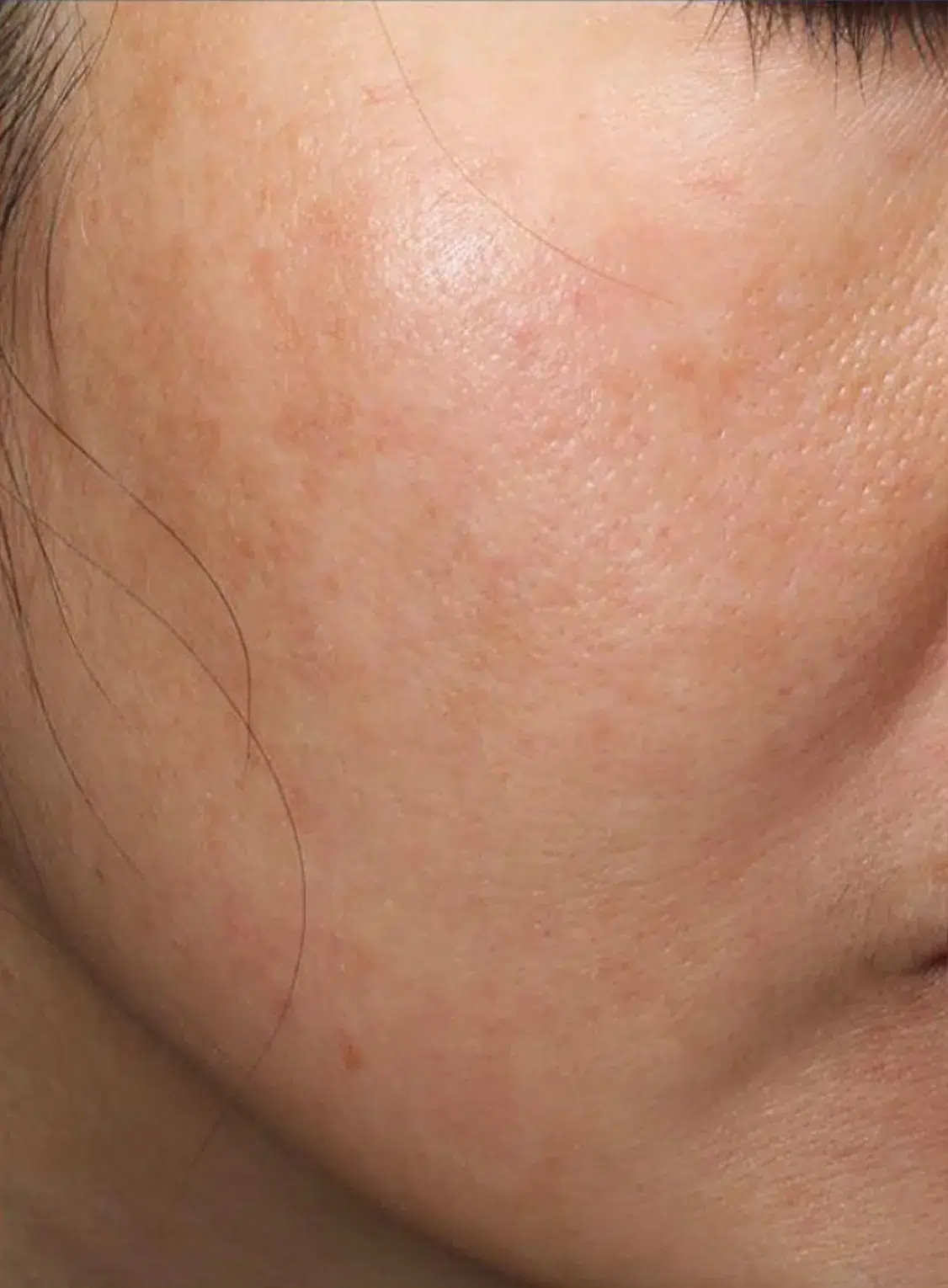 Pigmented Lesions — After Treatment · Case 20 · Luowei Medical Aesthetics Clinic