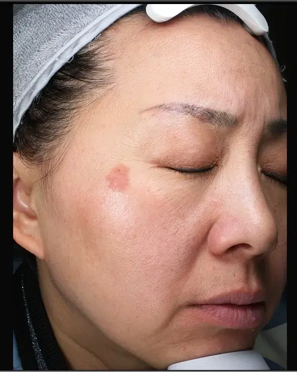 Pigmented Lesions — Before · Case 9 · Luowei Medical Aesthetics Clinic