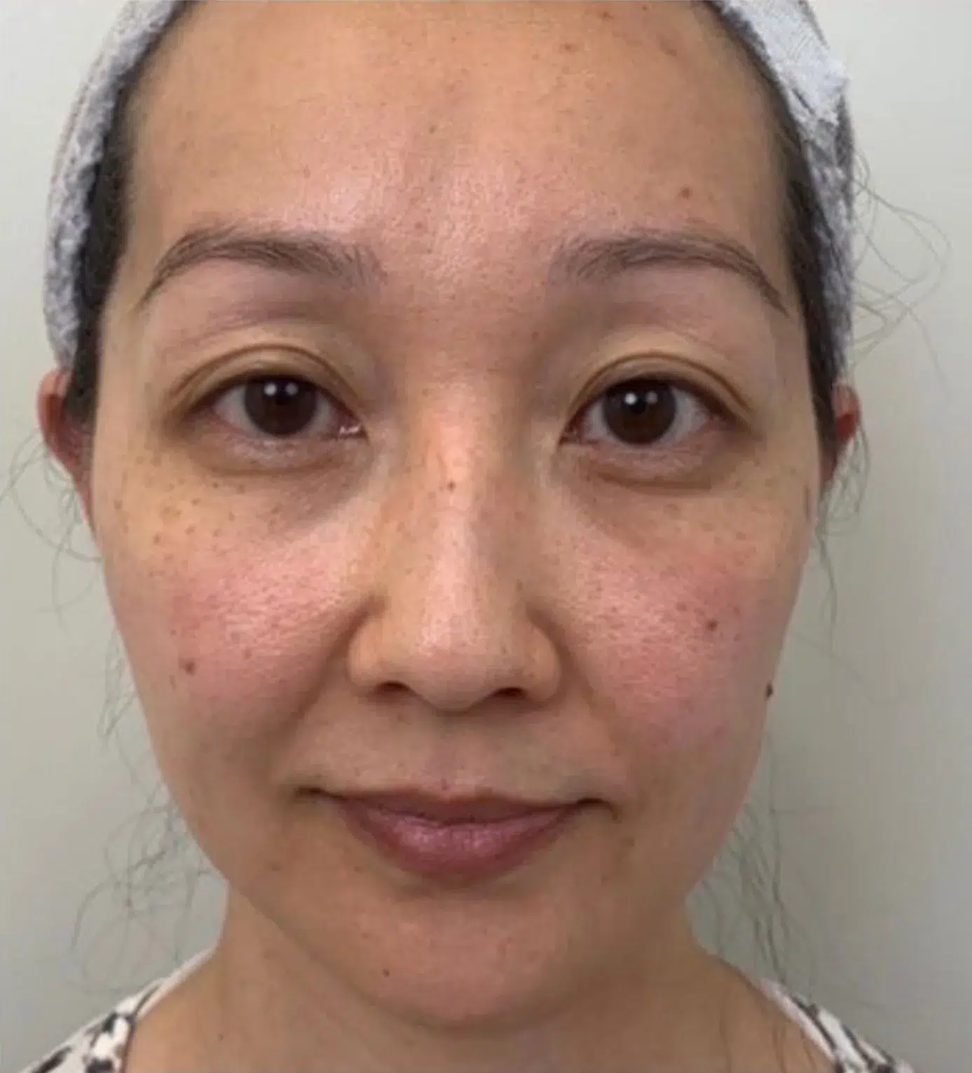 Freckles Before Treatment · Case 07 · Luowei Medical Aesthetics Clinic