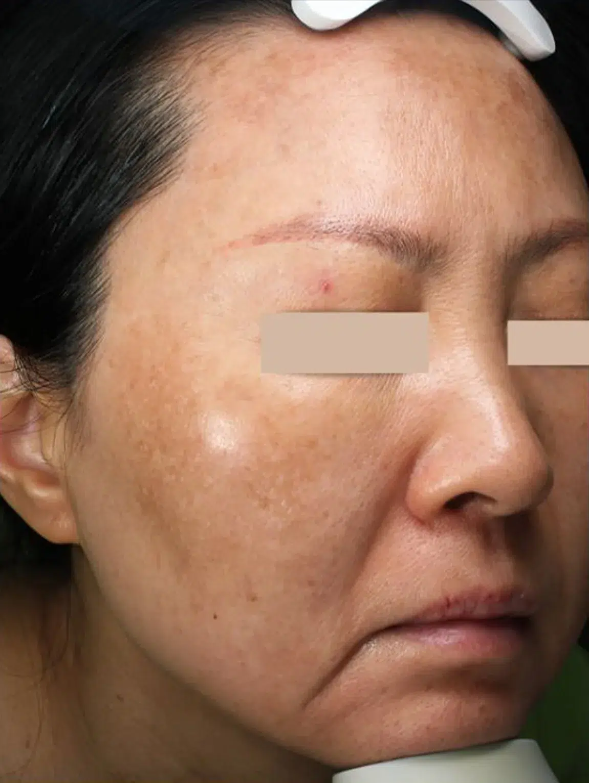 Freckles Before Treatment · Case 08 · Luowei Medical Aesthetics Clinic