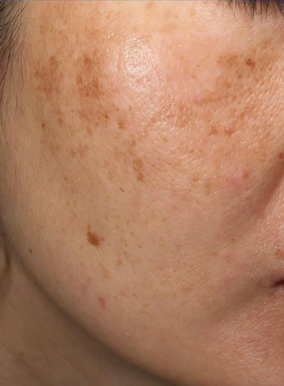 Pigmented Lesions Before Treatment · Case 20 · Luowei Medical Aesthetics Clinic